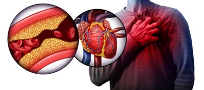 Phòng ngừa bệnh tim mạch do biến chứng của TĂNG HUYẾT ÁP nhờ sản phẩm thảo dược